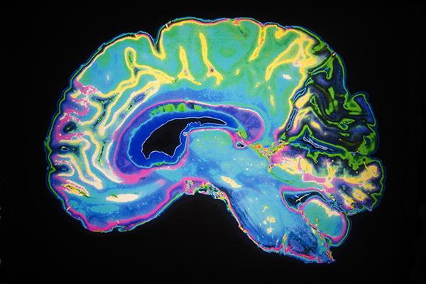 A colorful image of a brain from a scan